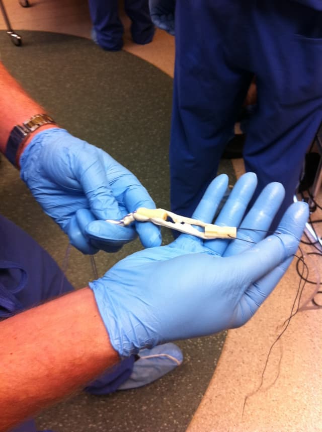 BTB allograft during knee implantation