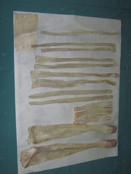 Tendon allograft illustration